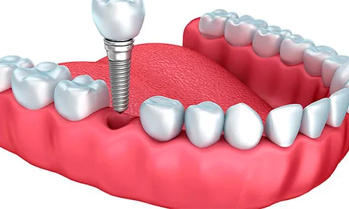 Implantes Dentários